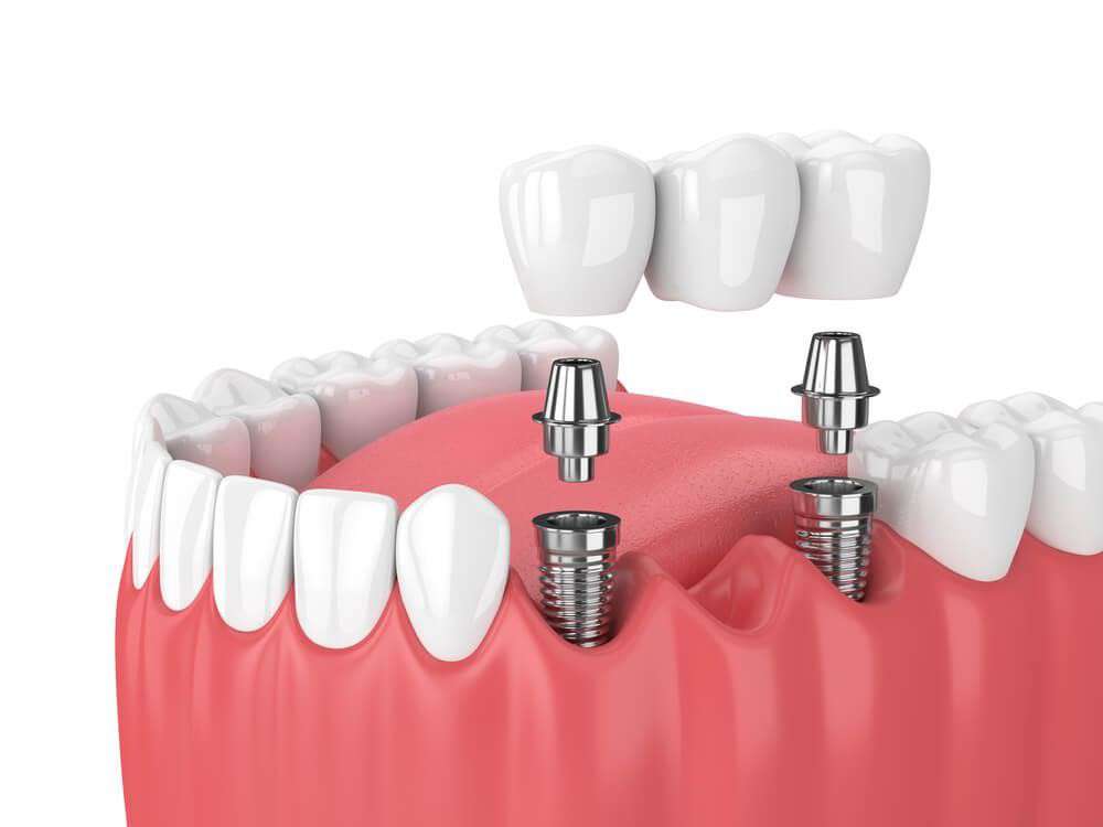 Как выбрать зубной имплант